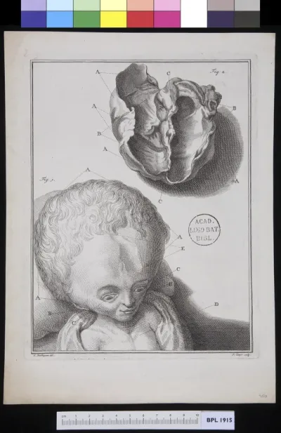 Head of a child with hydrocephalus