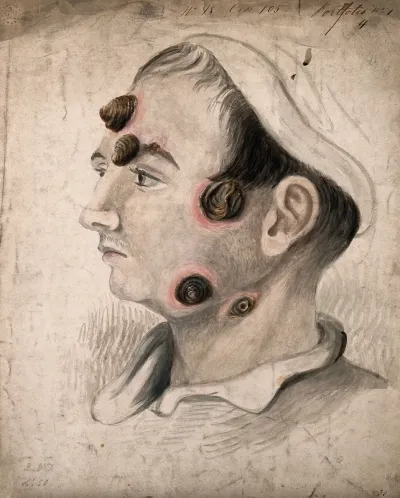 Head of a man with a severe disease affecting his face and neck