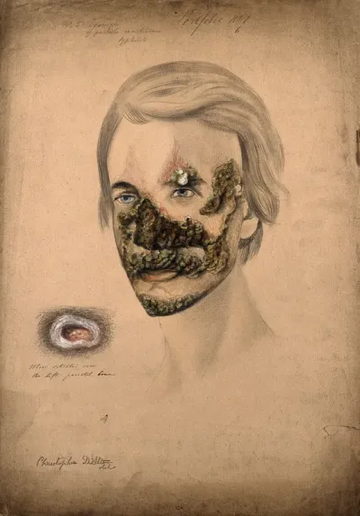 Head of a man with a severe disease affecting his face, and particularly his nose; and a detail of an ulcer on his face