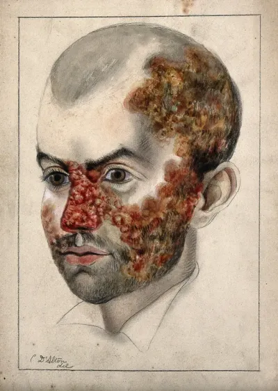 Head of a man with a severe disease affecting his face and scalp