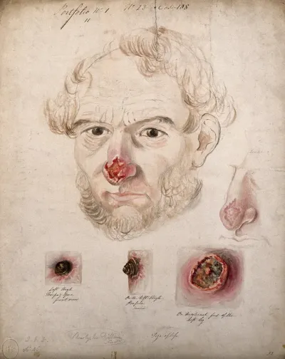 Head of a man with a severe disease affecting his nose; a detail of the nose, and three details of sores on his thigh