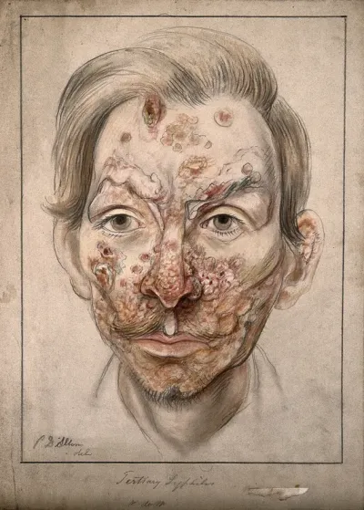 Head of a man with a syphilitic lesions affecting his face