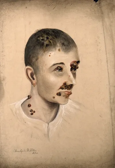 Head of a woman with a severe disease affecting her face and neck