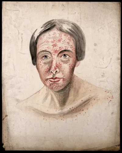 Head of a woman with a severe disease affecting her face and shoulders