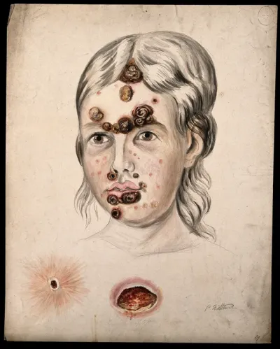 Head of a woman with a severe disease affecting her face; and two details of sores