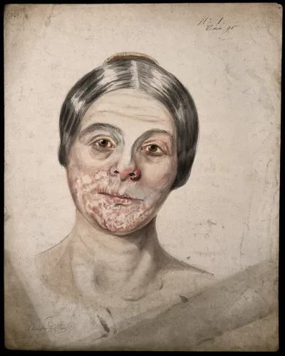 Head of a woman with a severe disease affecting her face