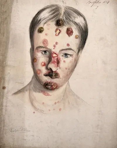 Head of a woman with a severe disease affecting his face and neck