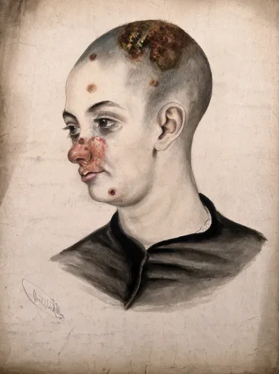Head of a young woman with a severe disease affecting her face and scalp