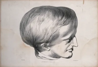Head of James Cardinal: a man with a deformed skull