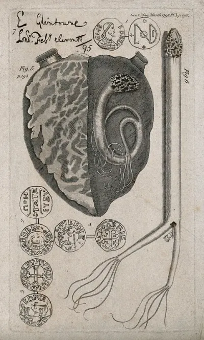 Heart with a snake-like polyp in the left ventricle: five figures including detail of the polyp and ancient coins(?)