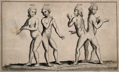 Hélène and Judith, siamese twins, known as the Hungarian sisters