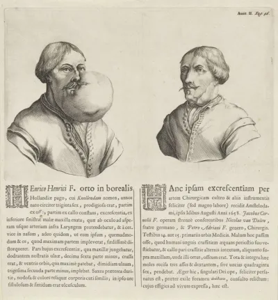 Hendrick Hendricksz van Knollendam vóór en ná een operatie van een tumor