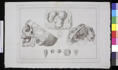 Human skull, different views, infection