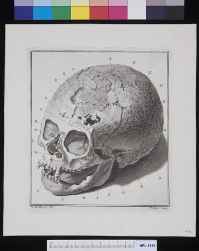 Human skull, fractures