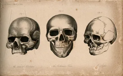 Human skulls: three figures showing the skulls of an ancient Cimbrian, an Estonian and Laplander
