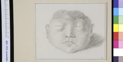 Hydrocephalus