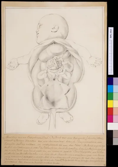 Infant with ascites