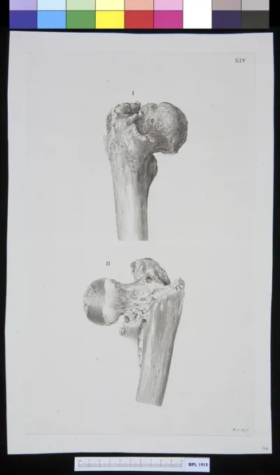 Infected bone (femur)
