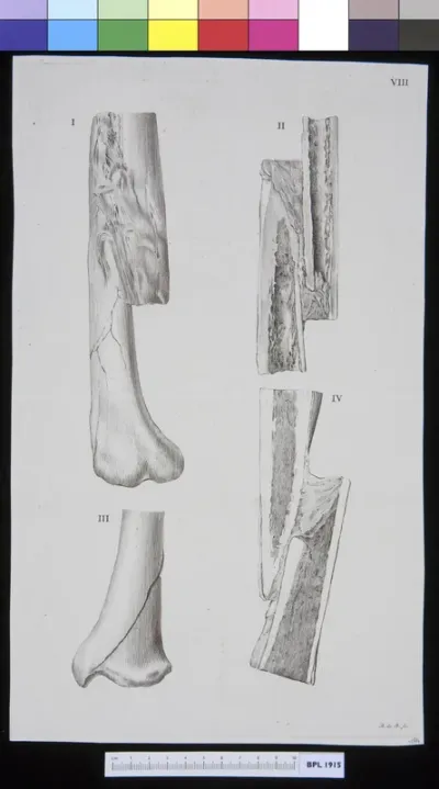 Infected bone