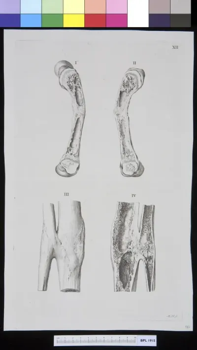 Infected bones, cross section (fibula and tibia?)