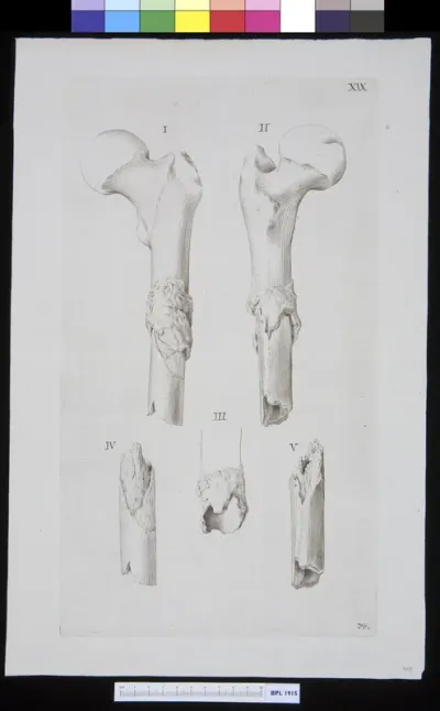 Infected bones (femur)