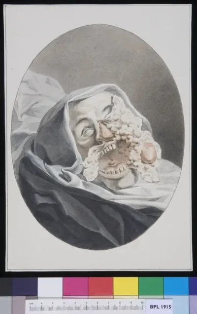Infection to a man's face exposed after his death
