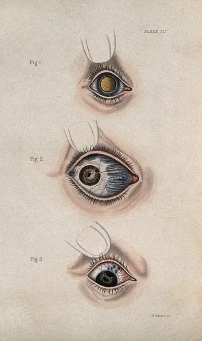 Inflamed bloodshot eye defects: three figures