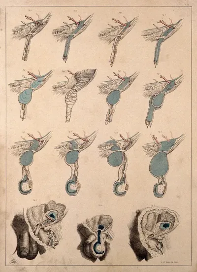 Inguinal hernia: fifteen figures