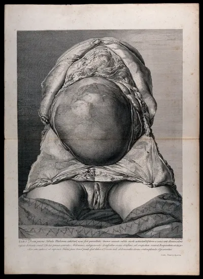 Initial dissection of the pregnant female abdomen, showing the skin peeled away to reveal the swollen uterus