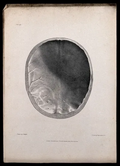 Inside the top half of a skull of an epileptic