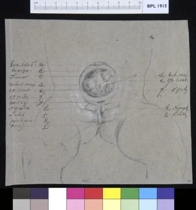 Intestines and genitals of a child, umbilical tumor