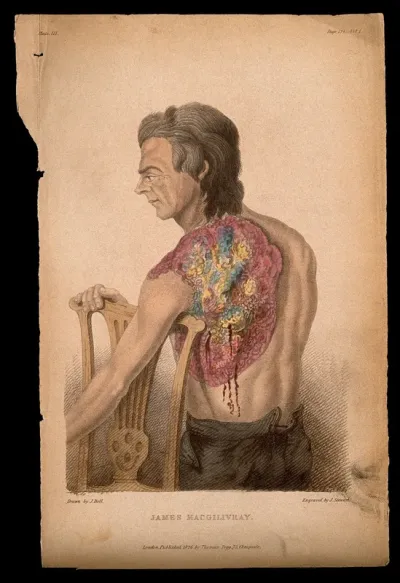 James M'Gillivray, a man shot in the shoulder in the siege of Nijmegen (1794): the shot developed into an ulcer which was cured by John Bell