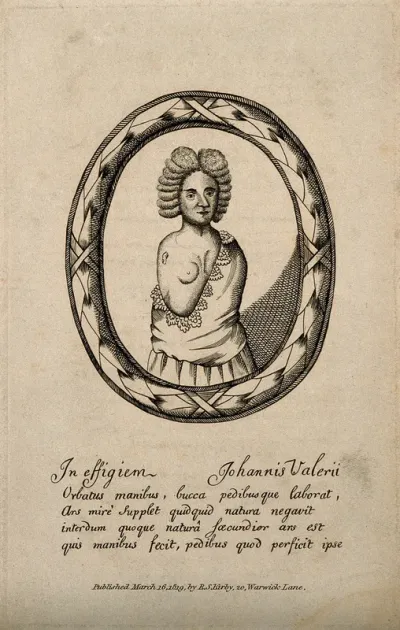 Johannes Valerius, a man born without hands or arms