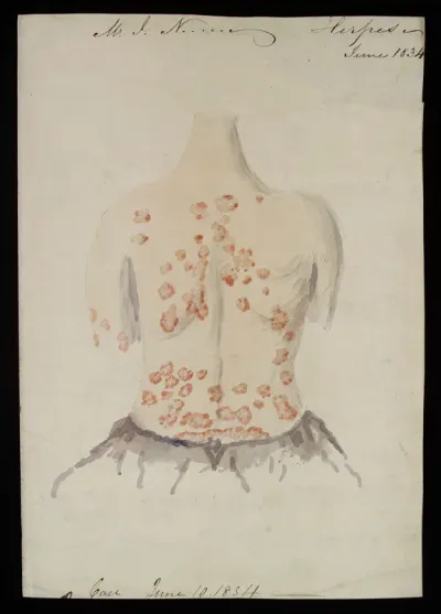 John Nevins, suffering from "herpes", skin disease on the back, possibly shingles