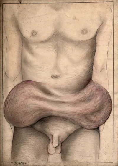 Large, severe swellings on the abdomen of a man