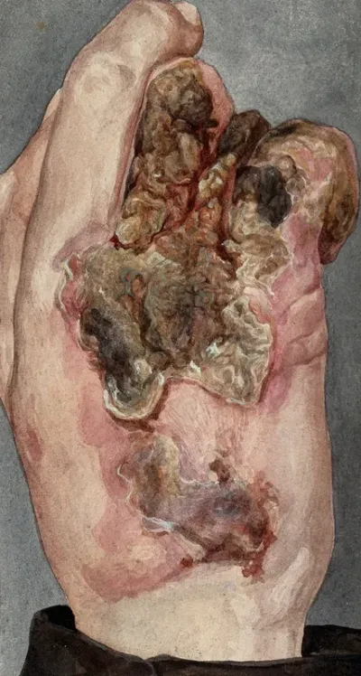 Lupus vulgaris: an inflamed, infected hand