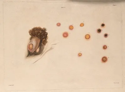 Male genitalia with a skin disease; and varieties of sores which appeared on other parts of the man's body