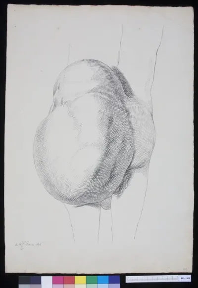 Man with a tumor growing from his buttocks