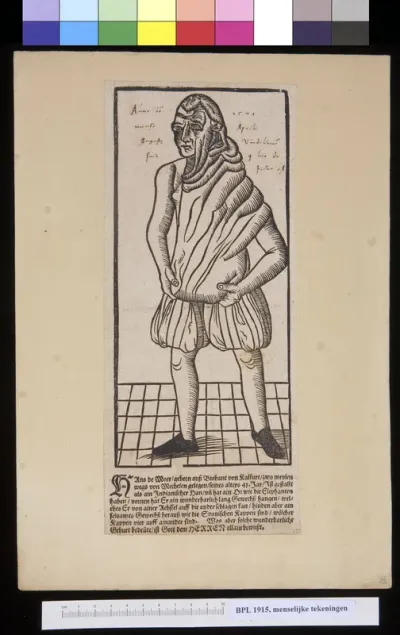 Man with elephantiasis of one ear
