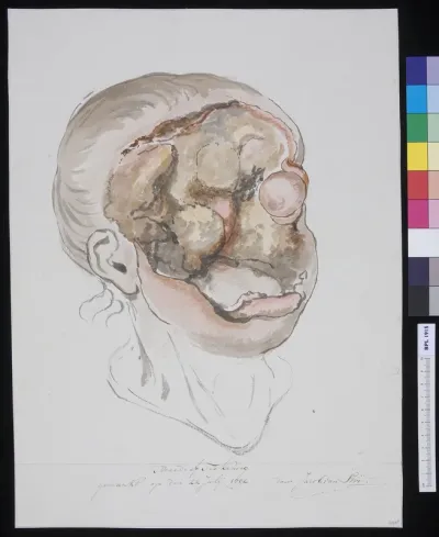 Man with severely deformed face
