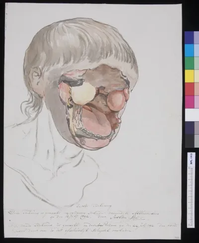 Man with severly deformed face