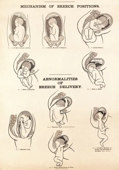Mechanism of breech positions and abnormalities of breech delivery