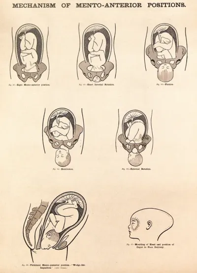 Mechanism of mento-anterior positions in childbirth