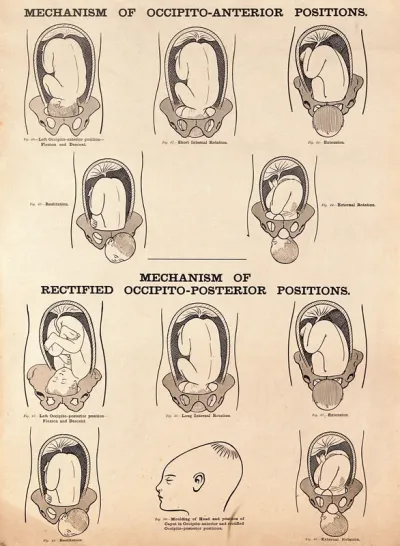Mechanisms of occipito-anterior positions and rectified occipito-posterior positions of the foetus