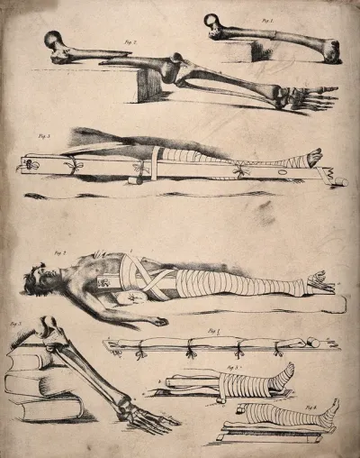 Methods of bandaging a broken leg: eight figures, showing femur and tibia bones broken at various points and the appropriate methods of applying bandages and splints