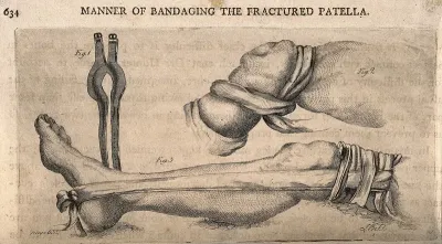 Methods of bandaging a fractured patella