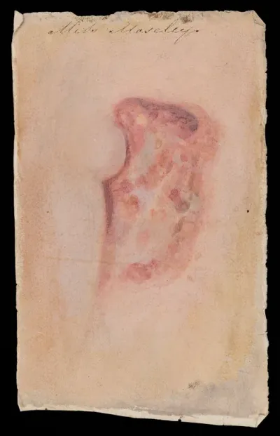 Miss Mosley, afflicted with breast cancer: detail of the cancer