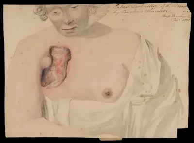 Miss Mosley, afflicted with breast cancer
