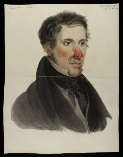 Mr Gledell, suffering from a rodent disease which has consumed his left nostril