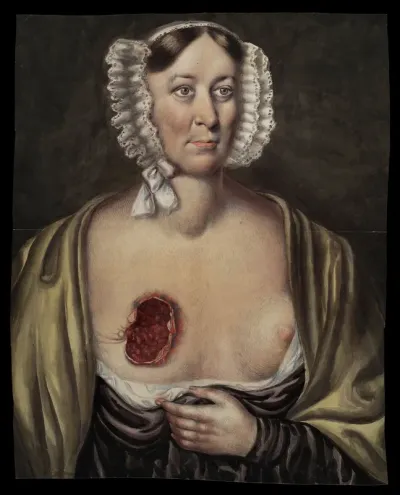 Mrs Prince, after surgical removal of a breast
